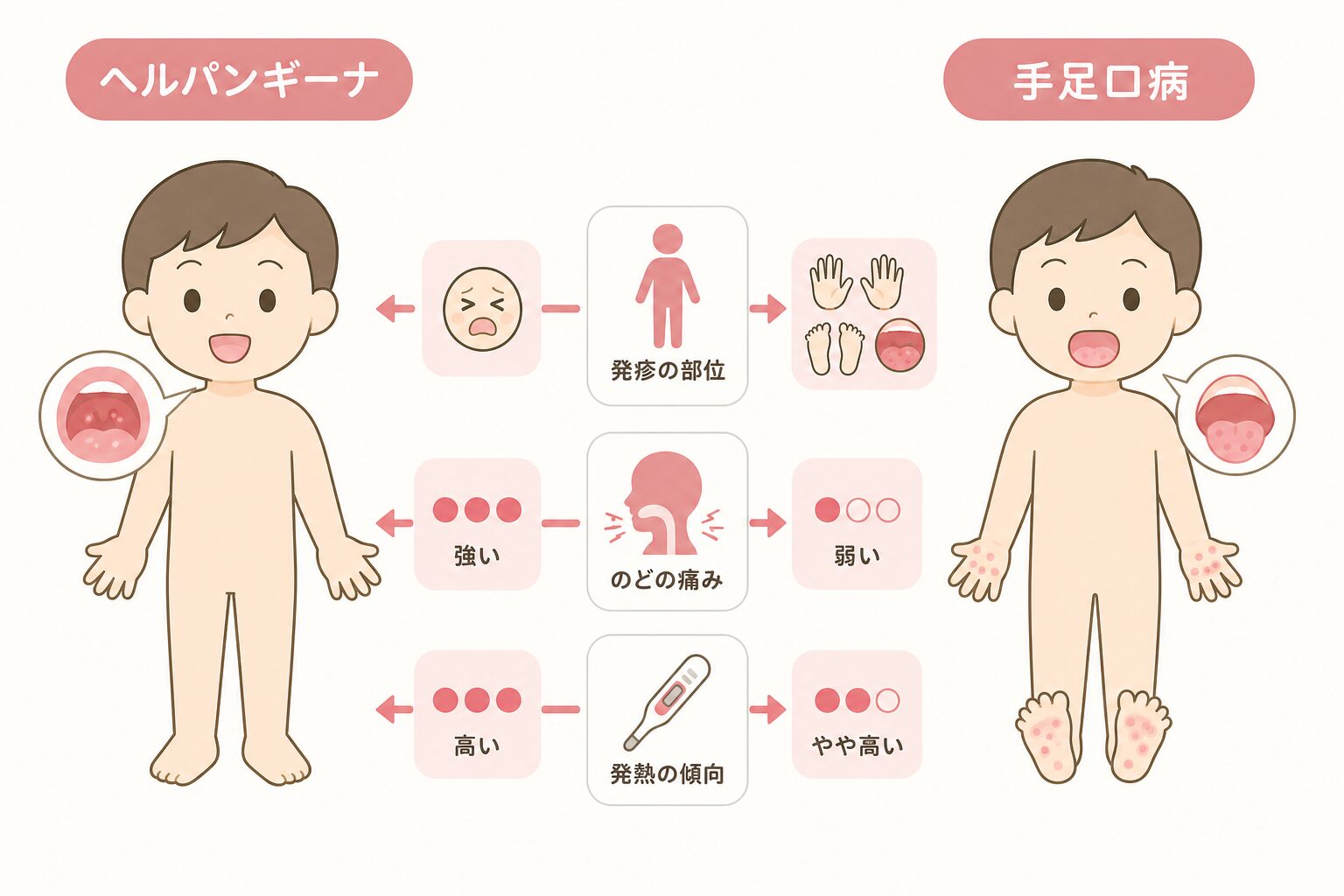 ヘルパンギーナと手足口病の発疹部位や症状の違いを大人向けに比較した図。
